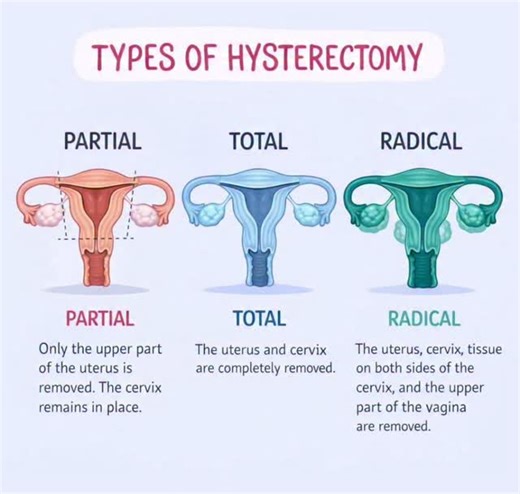 Neha Singh on Instagram: "Hysterectomy is a surgical procedure to remove a woman's uterus (womb). Here are the main types: 1. Total Hysterectomy: Removal of the uterus and cervix 2. Partial or Subtotal Hysterectomy: Removal of the uterus, leaving the cervix intact 3. Radical Hysterectomy: Removal of the uterus, cervix, part of the vagina, and sometimes surrounding tissues and lymph nodes (usually for cancer treatment) Approaches: - Abdominal Hysterectomy: Through an incision in the abdomen - Lap