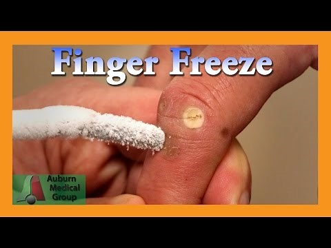 Finger Wart Cryotherapy Probe | Auburn Medical Group