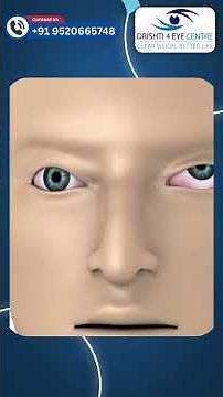 Squint correction video explained | Squint surgery results | best eye hospital for squint #squint