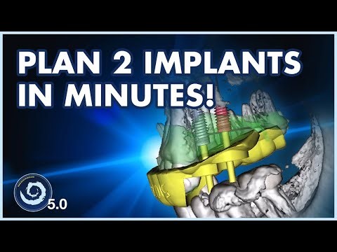 BSPV5: Plan 2 Implants in Minutes: The Ultimate Blue Sky Plan Workflow