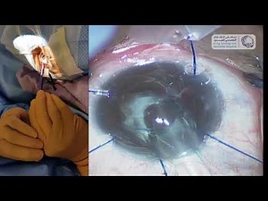 SECONDARY Sulcus intraocular lens implantation