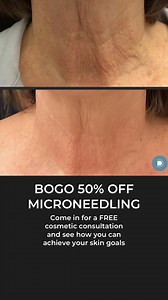 ✨ BOGO 50% OFF MICRONEEDLING! ✨ Amazing testimonial and real-life example of how #Microneedling can impact your #antiaging journey. Treat yourself and invest in your skin 🩵 ✨ Acne Scars ✨ Fine Lines & Wrinkles ✨ Stretch Marks ✨ Enlarged Pores ✨ Melasma ✨ Uneven Skintone Come in for a FREE consultation and learn how we can help you on your journey! Pssssttttttt..... $100 OFF any cosmetic treatment 👉 https://dermablue.com/aesthetic-consultation-v2/ TEXT: (844) 994-2744 CALL: (828) 585-5489 📞 #A