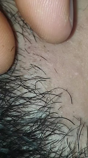 ingrown remove 115 على TikTok