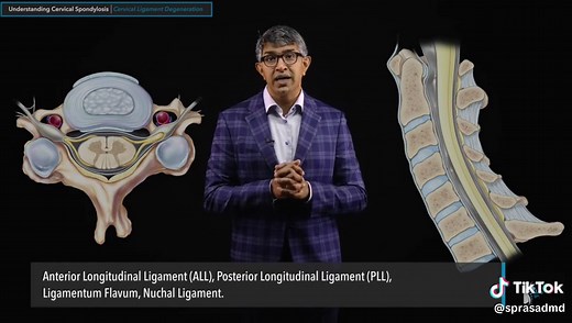 Understand ligamentum flavum hypertrophy and its impact on the spinal cord and nerves 🧠 #Surgeon #Medtok #SpineSurgery #MedEd