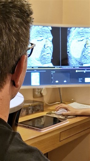 Kenny’s results from The Skin Makeover are in… A few months of personalised care and professional expertise have brought Kenny’s skin to a renewed state of calm and confidence. Through a series of customised in-clinic treatments, including our signature 3D MD PRP and 3D Medical Skin Needling, as well as chemical peels and IPL treatments, we achieved beautiful results. His home care was essential in achieving these results... We are truly grateful to our product partners for supporting this trans