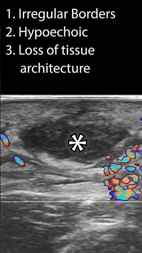 Characteristics of an Abscess #pocus #ultrasound