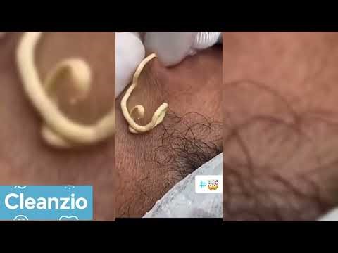 #041 BIGGEST BLACKHEAD REMOVAL EVER | Extreme Pore Cleaning