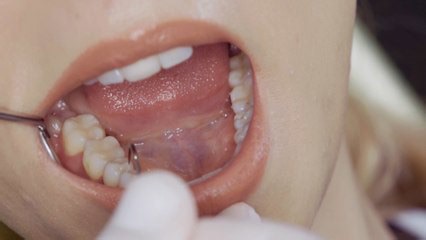 6.2 million patients waiting for an NHS dentist appointment: How to take care of your teeth if...