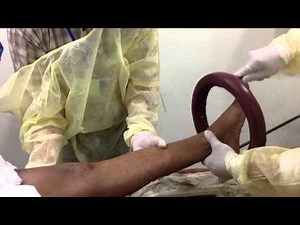 applying thomas splint