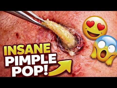 INSANE Blackhead Extraction! 😱 Biggest Pimple Popping Ever Caught on Camera