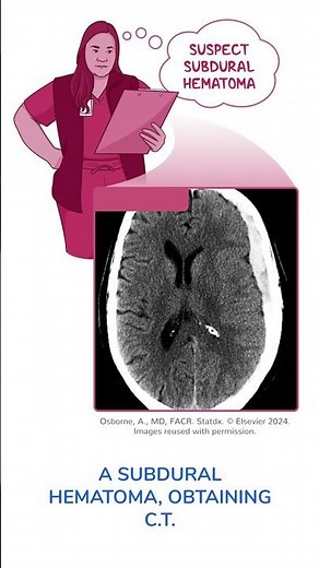 Diagnostics on Demand: Subdural hematoma