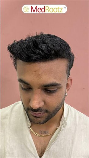 Transformative 4,195-Graft Hair Restoration | MedMagic at MedRootz
