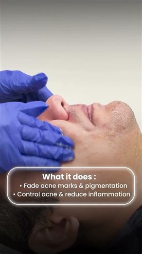 How to Remove Acne Marks & Pigmentation (Dermale Peel) | Best Treatment for Active Acne and Scars 🩸