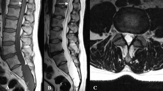 Sacral Intradural Arachnoid Cyst of Cauda Equina: A Comprehensive Case Report and Literature Review – Archyde