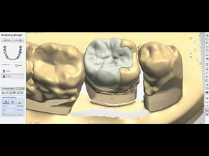 Onlay (Inlays and Veneers)