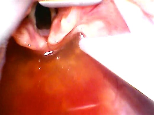 [129] Fluid Flow During Laryngoscopy; OOHCA