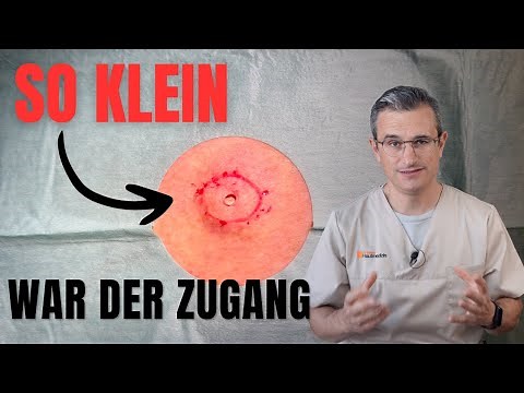 Talgzyste am Rücken entfernen: Dr. Kasten Hautmedizin in Mainz epidermal cyst removal Dana procedure