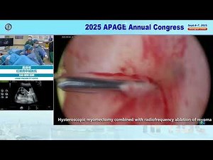 Live surgery: Multiple fibroids, treated with TCRM and RFA abaltion |Ablation|RFA
