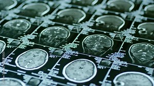 Close up of MRI scan of brain with coronal, axial and sagittal planes