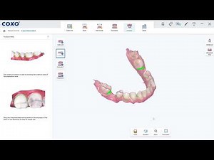 Amprentare dentara digitala cu Scannerul Intraoral DL-300P COXO - demonstratie live