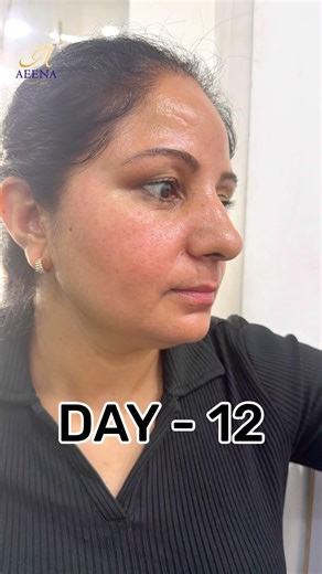 Cosmelan Peel Results | 15 Day Pigmentation Transformation 😍 | AEENA YOUTH CLINIC