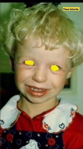 Elfin facies / William Syndrome facial characteristics #medical #medicine #face #shorts #reels