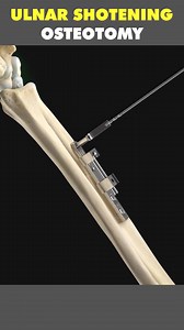 Ulnar Bone Shortening Osteotomy 3D Animation #ulnarosteotomy #ulnarbone #ulnarshorteningosteotomy #ulnarshortening #ulnarshorteningsurgery #ulnarsurgery #bonesurgery #osteotomy #osteotomysurgery #boneshorteningosteotomy #medical3danimation #3dmedicalanimation | Mix Dancing Events