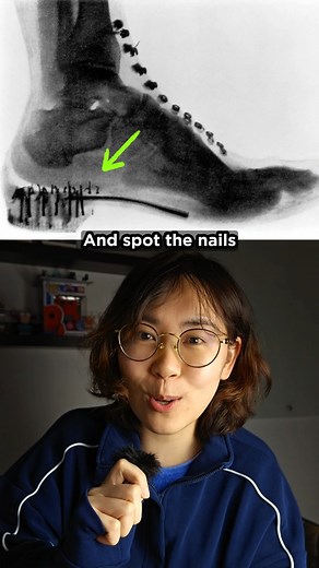 Why Did Kids Put Their Feet in X-Ray Machines? The shoe-fitting fluoroscope, also known as a pedoscope, was an X-ray fluoroscope machine commonly installed in shoe stores from the 1920s until about the 1970s. It allowed customers, especially children, to view the bones of their feet inside shoes in real time, helping assess whether the shoes fit properly. Marketed as a modern, scientific tool for better shoe fitting, it became a popular feature in stores across Europe and North America. However,