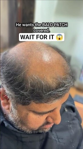 Baldness covered with Braids 😲🤯 | No Pain | No Chemicals | No Damage | Hairstyle name : CORNROWS
