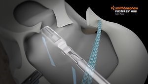 Meniscal Root Repair: One Tunnel Technique Animation