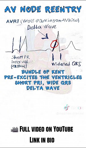 ECG Study Note: WPW Pattern. Accessory pathway and delta wave overview. #ecg #medicaleducation #cardiology #nursingstudent #electrophysiology