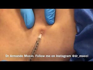 A small epidermoid cyst