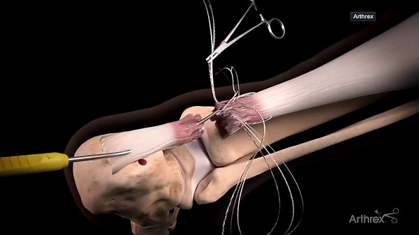 2.9K views · 100 reactions | Did you catch Arthrex Achilles Midsubstance SpeedBridge™ on ESPN today? Thank you to Injury Analyst Stephania Bell for sharing insight on the type of procedure NFL star Aaron Rodgers underwent. Learn how this minimally invasive repair can benefit athletes competing at any level: https://arthrex.info/48hD3je #Arthrex #Achilles #AchillesRepair #ESPN #FFNow #NFL #NYJets #AaronRodgers #SpeedBridge #Innovation | Arthrex | Facebook