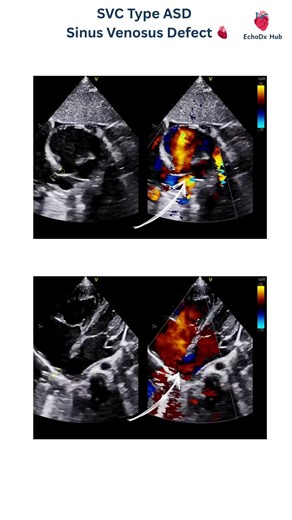 SVC Type ASD | Sinus Venosus Defect 🫀 #heartdisease #echocardiography #cardiologyeducation