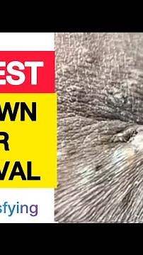 Largest Ingrown Hair Removal | Oddly Satisfying Hair Extraction|