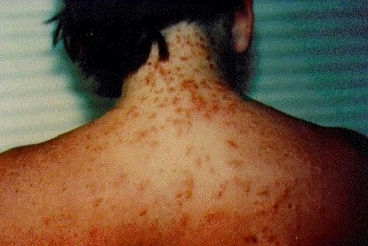How Do You Avoid Sea Lice Bites?