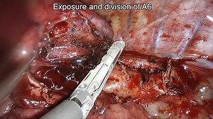 Infrared thoracoscopic extended lobectomy with intravenous indocyanine green administration