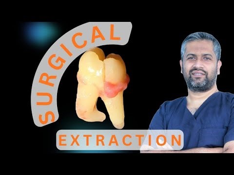 SURGICAL EXTRACTION OF CURVED IMPACTED 38 BY SECTIONING. 4K