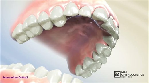 Bilateral Posterior Crossbite Explained | How Expansion Corrects It