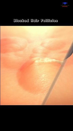 Hidradenitis Suppurativa ,, condition that causes small, painful lumps under the skin.#treatment