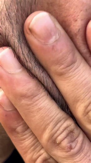 Ingrown hairs massage 💆 #satisfying #amsr #tweezer #sounds #pimple #thebarbersarms #lashes 🤏🏼👌🏻