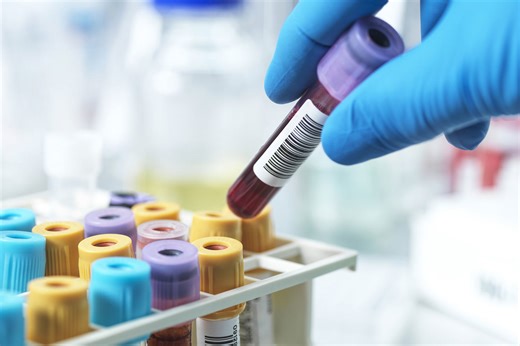 Cholesterol screening and treatment advised for people in their 30s, new guidelines suggest