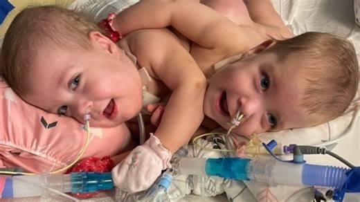 Indiana native leads surgery to separate conjoined twins