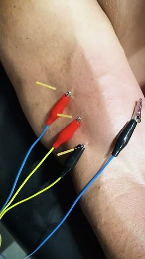Dry Needling Helps with Tennis Elbow!
