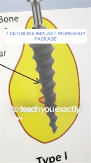 🎯 New LIVE 7 C.E. Online Implant Workshop with Dr. Andrea Smith! 🔥 Learn the Single Tooth Implant technique using One Piece Implants 🔥 Learn One Piece Dental Implant Anatomy, Implant Site Selection, and Placement Protocol. 🔥 Learn the Armamentarium and Different Types of One Piece Dental Implants. Join me on this unique workshop to learn how to place one piece implants for single missing teeth! https://webinars.dentalpracticemastery.com/one-piece-implant-workshop-registration | Dr. Rinesh Ga