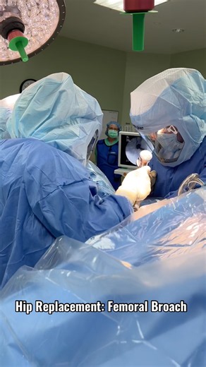 The Hidden Step in Every Hip Replacement: Femoral Broaching