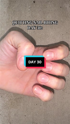 Day 30: Overcoming Nail Biting