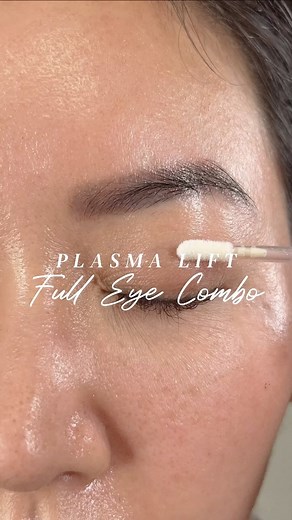 4.9K views · 30 reactions | Plasma Lift Full Eye Combo✨ Fibroblast...