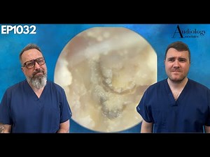 Removing a FUNGAL INFECTION from someone's EAR CANAL - EP1032