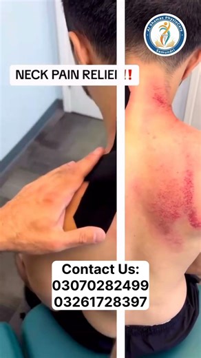 گردن کا درد آج کل غلط پوسچر، موبائل اور کمپیوٹر کے زیادہ استعمال کی وجہ سے عام ہو چکا ہے۔